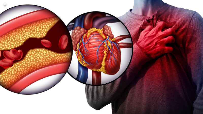 Hipercolesterolemia o exceso de colesterol Hipercolesterolemia o exceso de colesterol